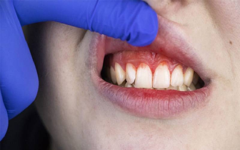 Treating Oral Infections