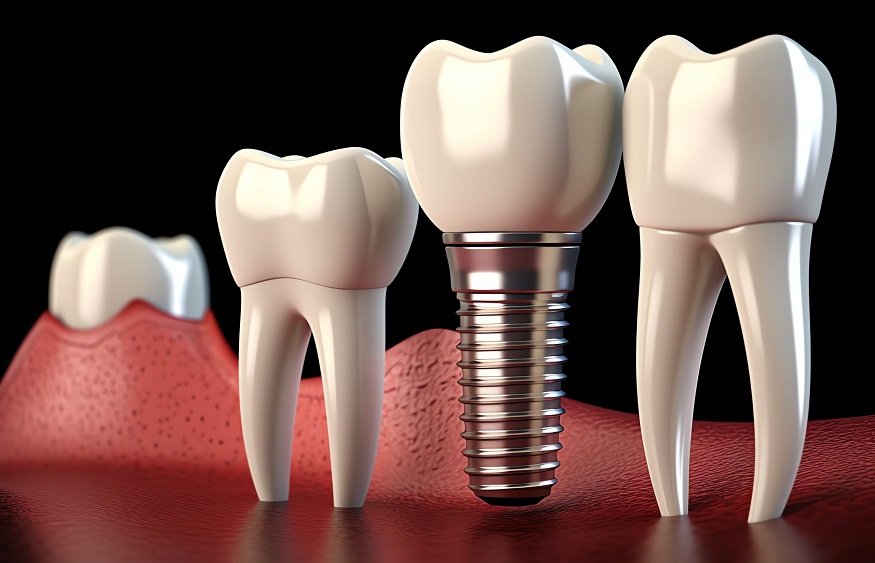 Dental Implant Success Rates