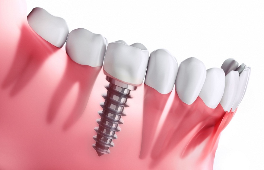 Dental Implants For Long-Term Use