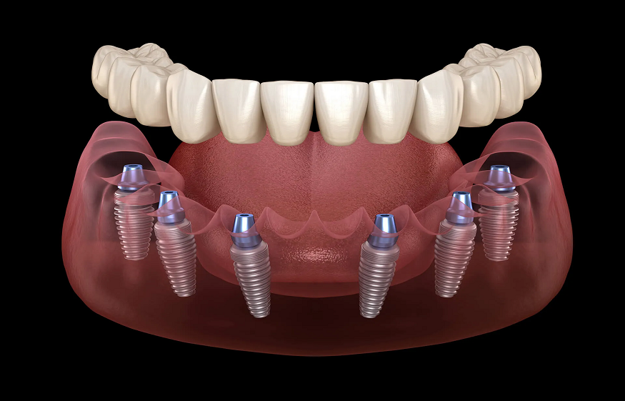 Dental Implants Rancho Cucamonga